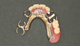 治療後：金属床義歯（金属とプラスチック）