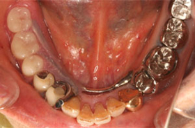 古い義歯 の口腔内写真