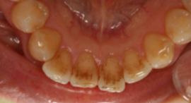 PMTC�E���̃N���[�j���O�O