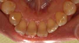 PMTC�E���̃N���[�j���O��