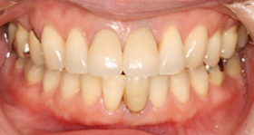 �z�[���z���C�g�j���O��A��̑O��2�{���I�[���Z���~�b�N�X�ł�蒼���܂����B