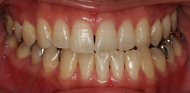 �z���C�g�j���O�@�Q�T�Ԍ�