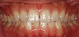 �z���C�g�j���O�@1�T�Ԍ�